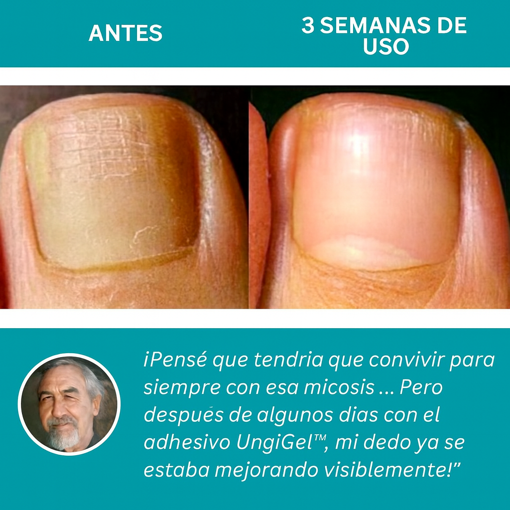 Adhesivo reparador de uñas – Tratamiento antifúngico avanzado