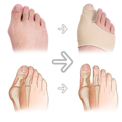 Corrector de Juanete de Silicona – Hallux Valgus Ortopédico