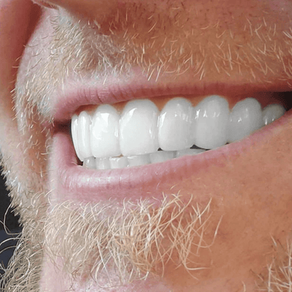 EasySmile | Carillas dentales cerámicas adaptables (juego superior e inferior)