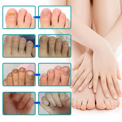 Adhesivo reparador de uñas – Tratamiento antifúngico avanzado