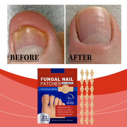 Adhesivo reparador de uñas – Tratamiento antifúngico avanzado