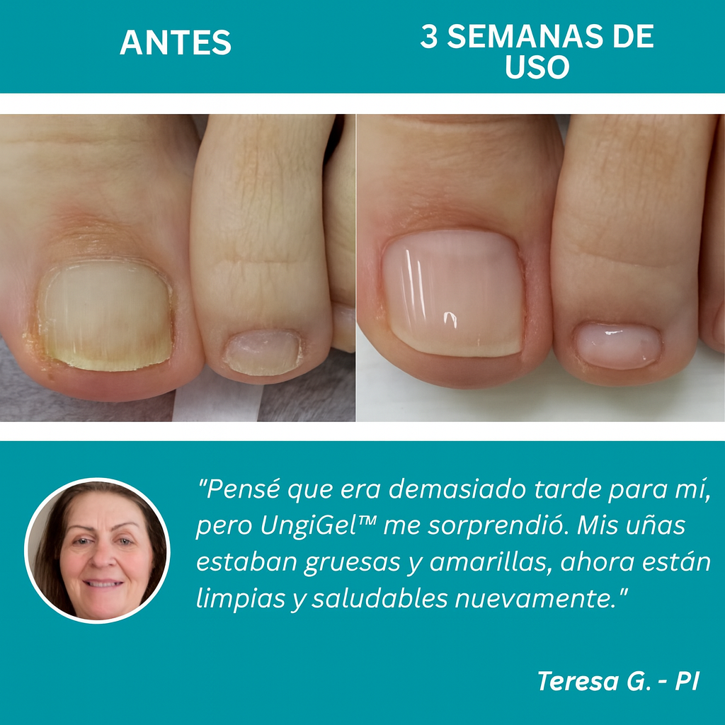 Adhesivo reparador de uñas – Tratamiento antifúngico avanzado