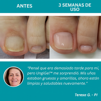 Adhesivo reparador de uñas – Tratamiento antifúngico avanzado